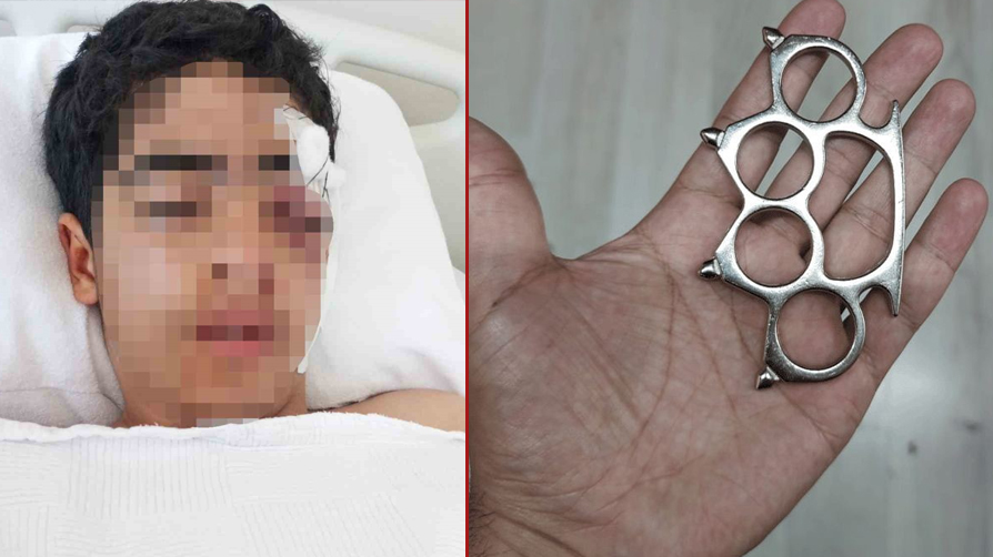 Muştalı akran vahşeti! 15 yaşındaki çocuk bu hale geldi